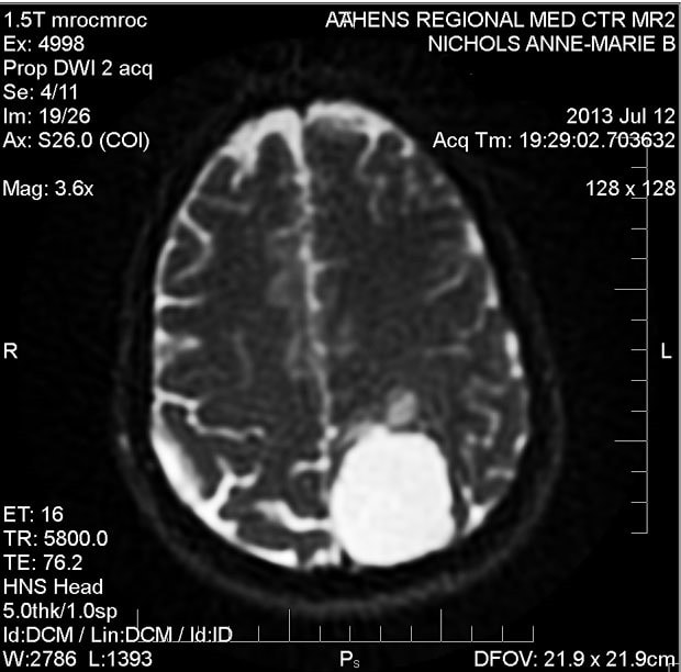 MRI of a menigioma.