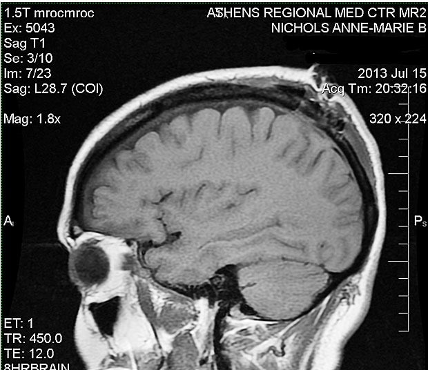 MRI after the menigioma was taken out.